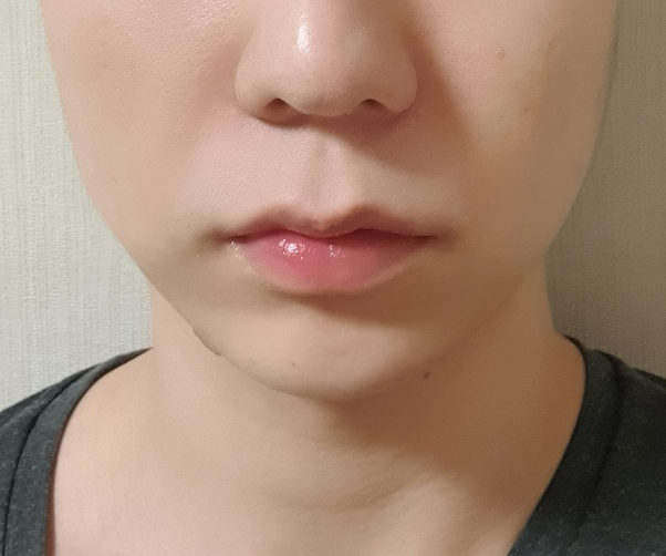 이중턱 지방흡입 2개월차 후기입니다~!