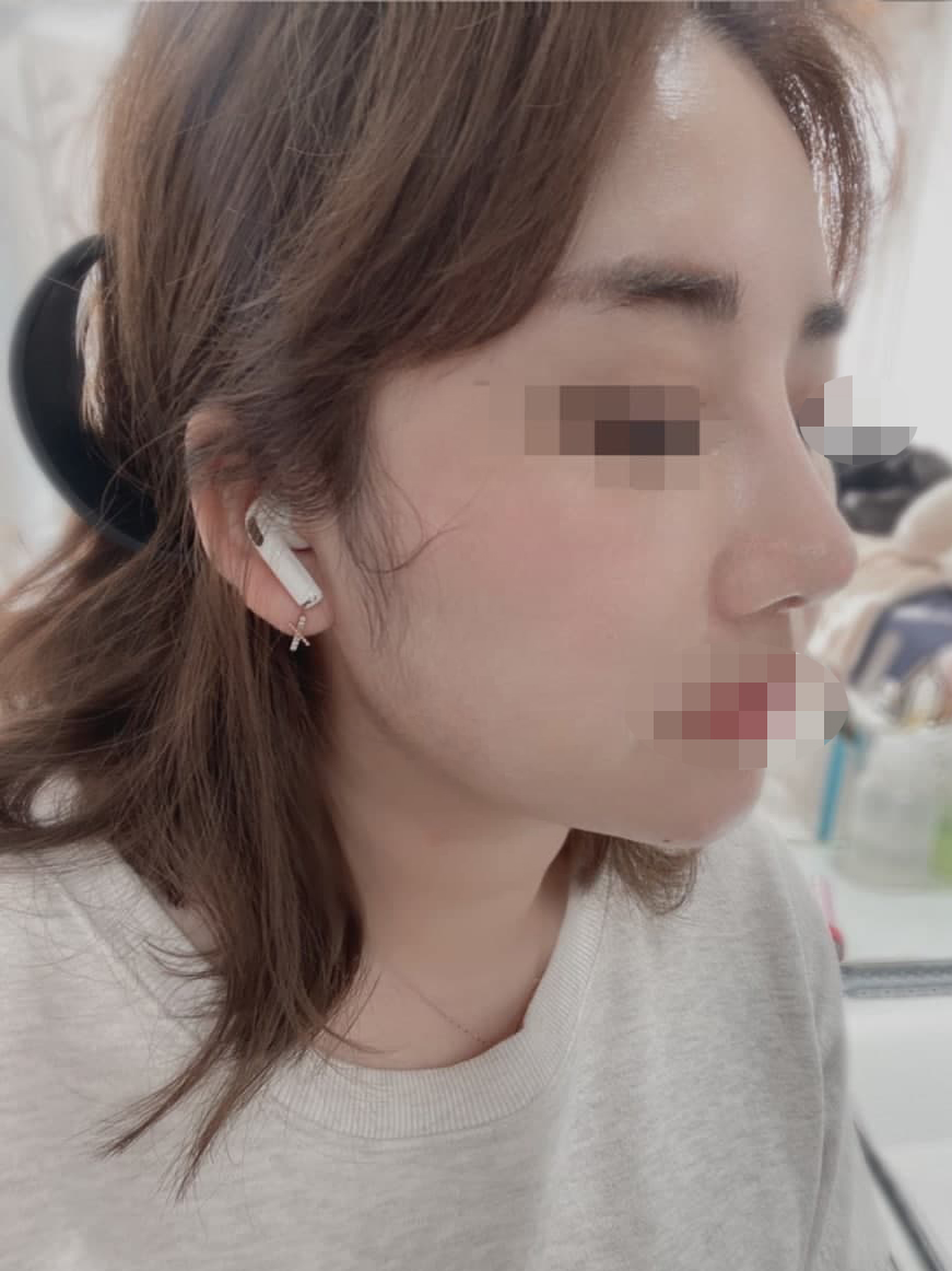 한달후기 (코,이중턱흡입)