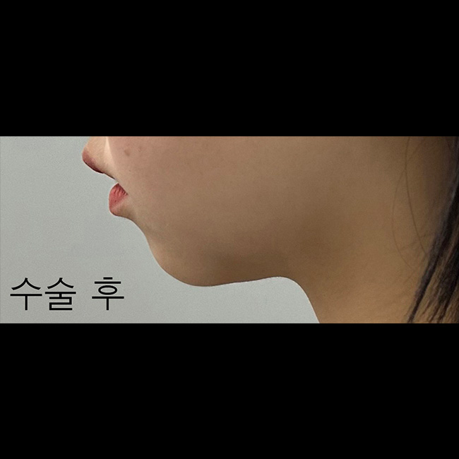 수술후_1_-2.jpg