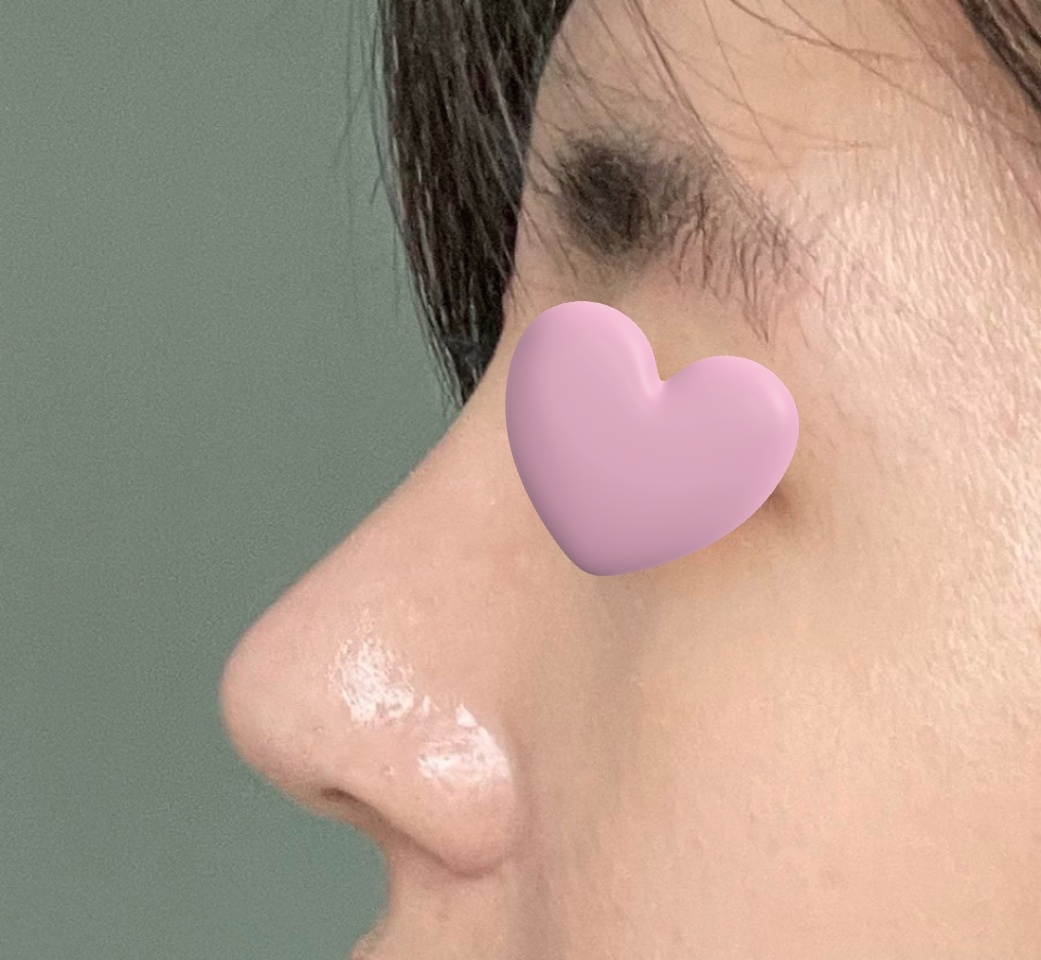 무보형물 매부리코수술 4달 지나고 쓰는 후기