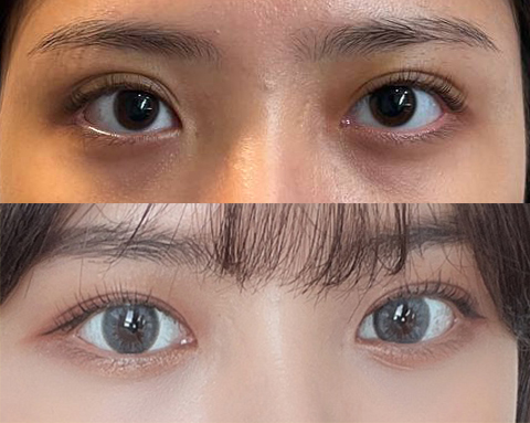 눈성형 바이브에서 하세용ㅎㅎ