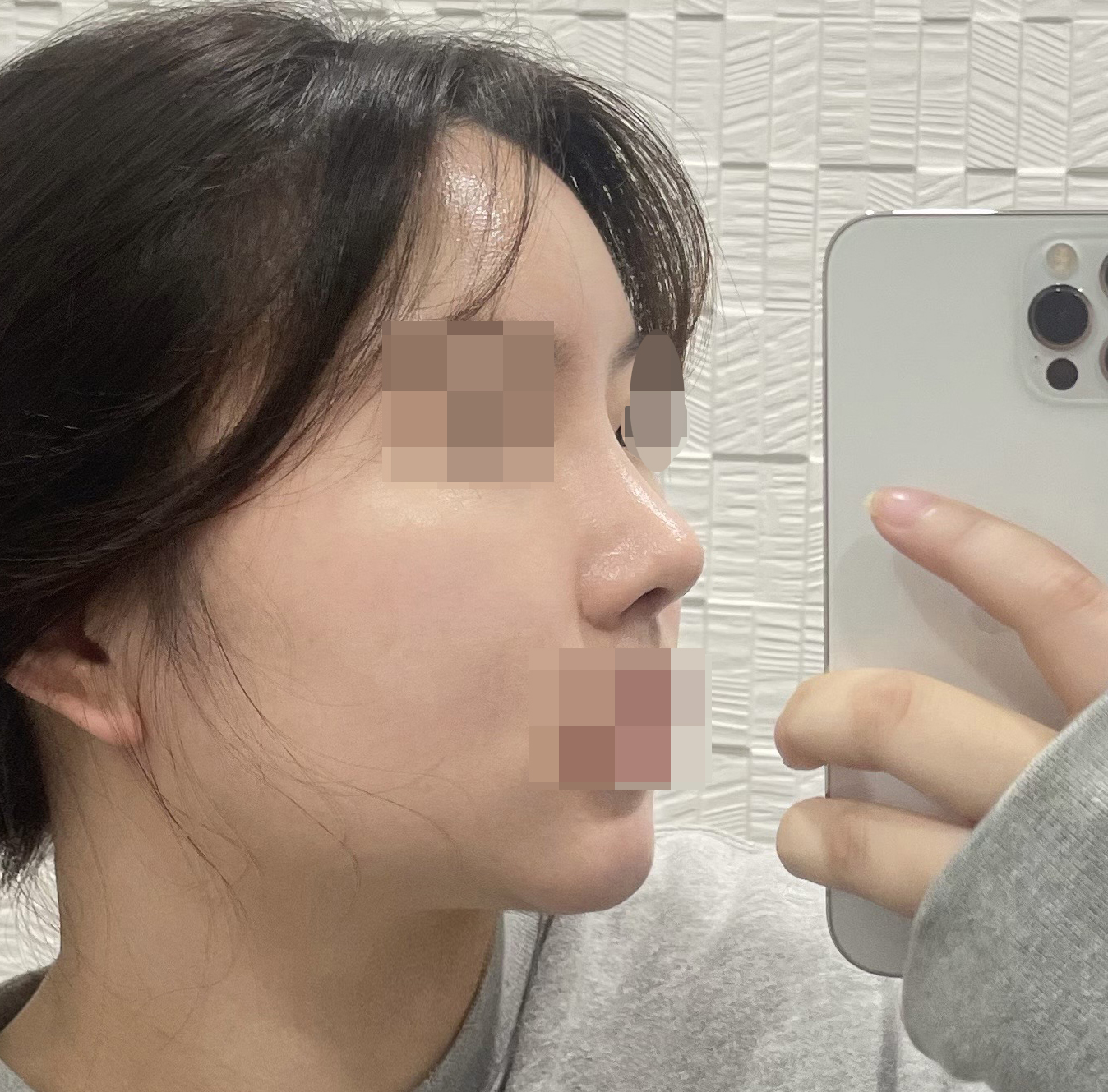 바이브에서 코랑 지방이식하고 만족후기 씁니다!