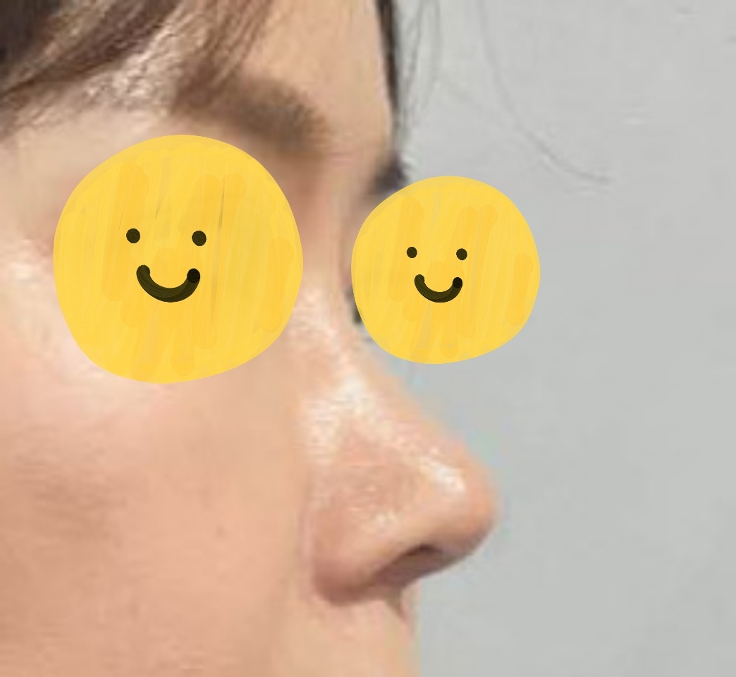 눈/코 6개월지나고 후기써요~^^