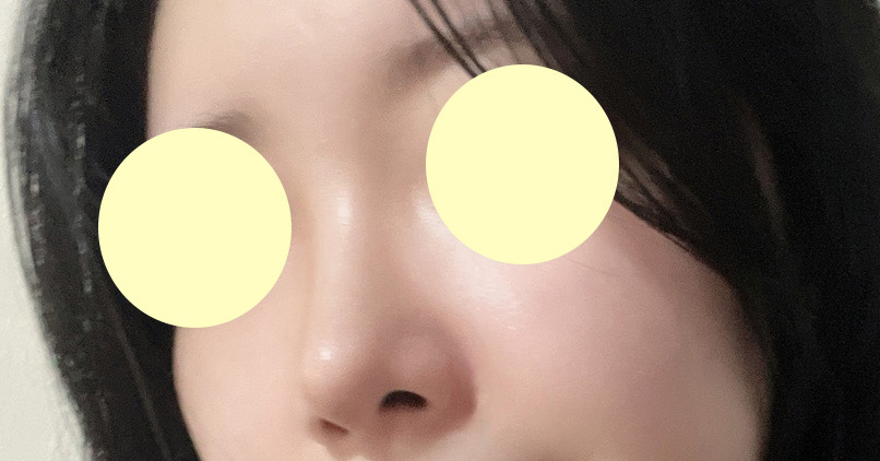 무보형물 3개월차 그냥 예쁜코에요 !