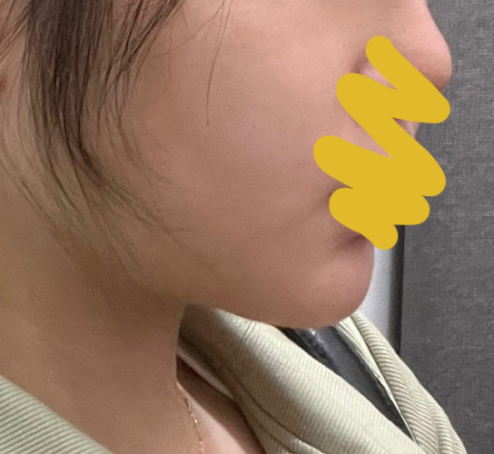 바이브 얼굴지방흡입수술 효과 굿굿