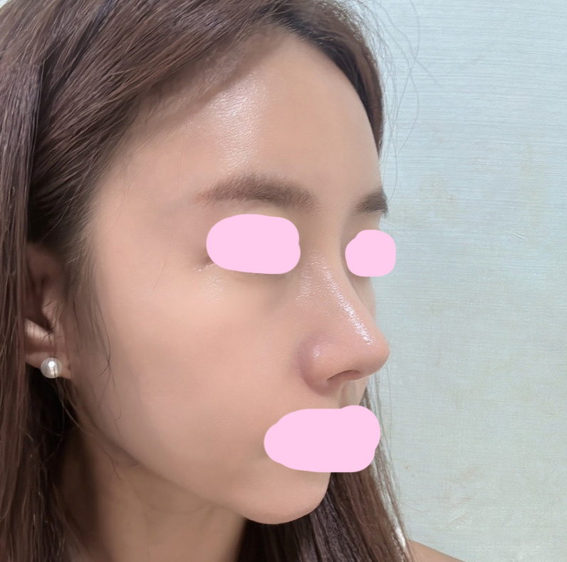 수술결과 만족도100%!!