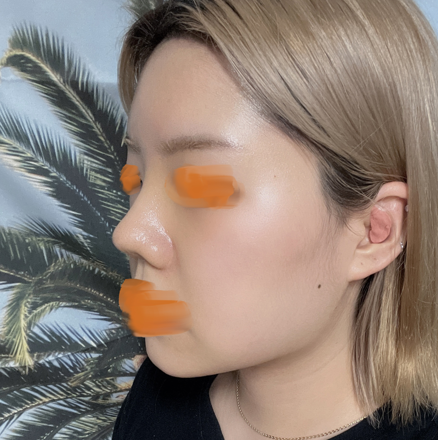 바이브 수술 1개월차! 성공적!