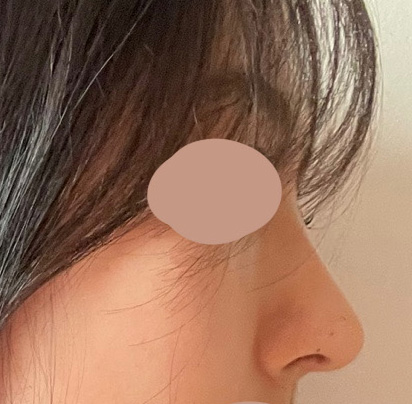 무보형물코성형하구 다들 잘됐대요 ㅎㅎ