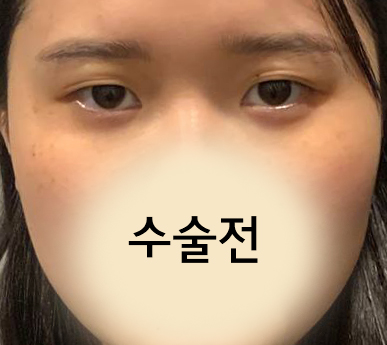 수술전_1_.jpg