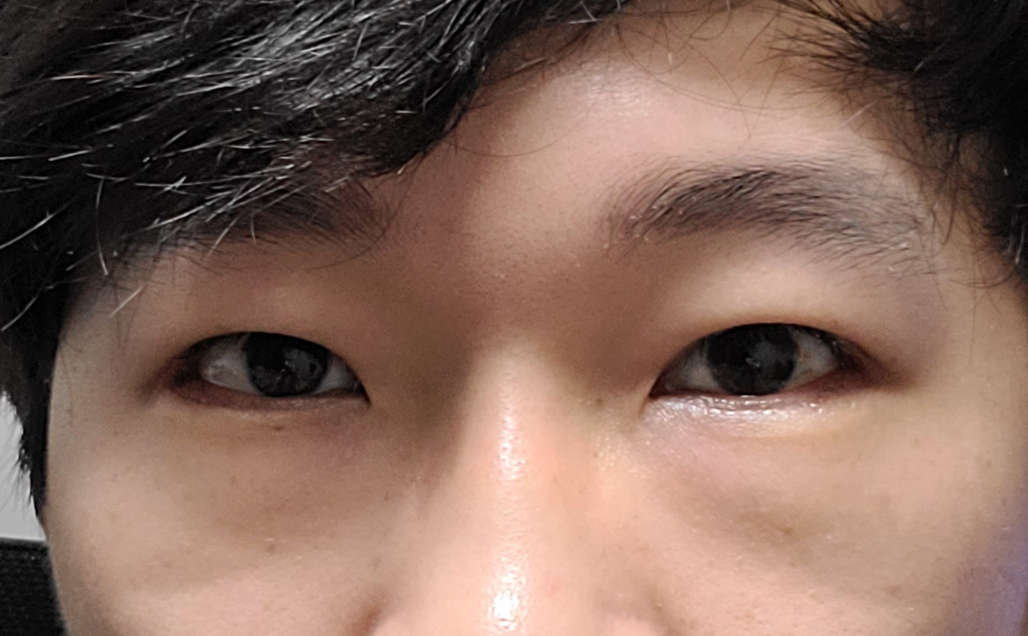 남자 절개눈매교정, 밑트임, 뒤트임했습니다.