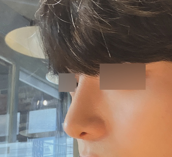 남자코성형 후회없어요!