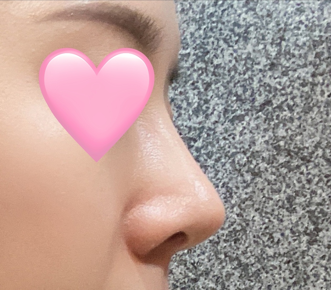 원장님실력 최고최고!(눈+코후기)