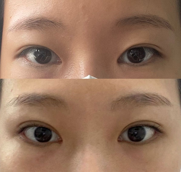 눈재수술 후기입니당