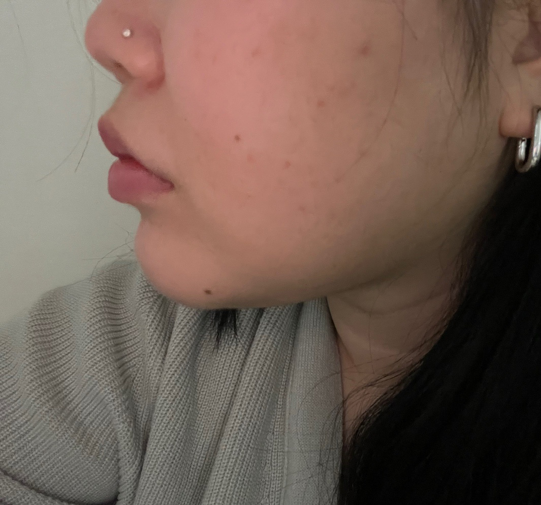 지방흡입은 고민없이 바이브추천ㅎㅎ