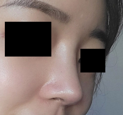 수술후_2_-코,_턱-1.jpg