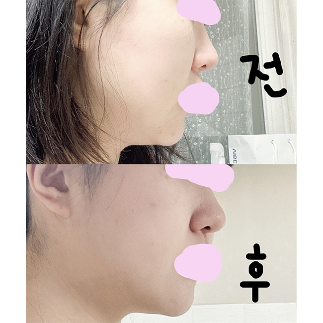 끝장지방흡입 최고 ㅠㅠbb