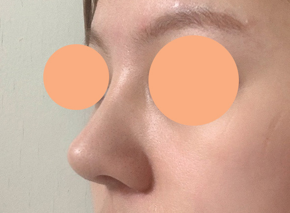 코재수술 받은지 3주차