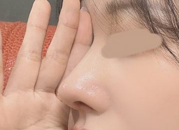 고민끝에 바이브에서 코수술!