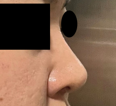 코수술 만족하고 있어요 ㅎㅎ 4개월차!