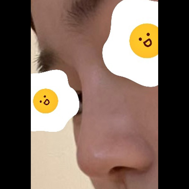 코수술한지 한달됐어요!