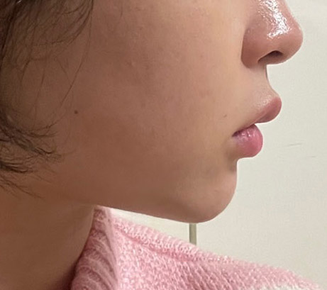 이제야 턱살이랑 이별했어요!