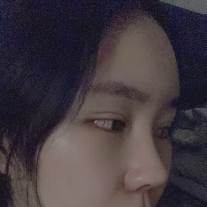 눈 재수술, 코 재수술 자가늑 후기~