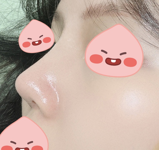 코수술잘돼서 주변에도 추천해줄 정도에요 ㅎㅎ