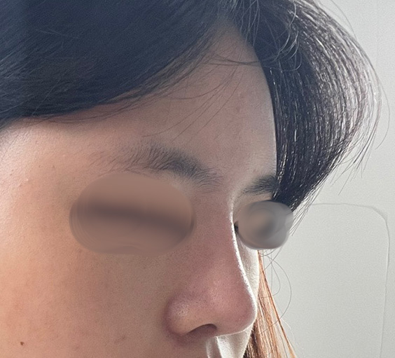 코, 지방이식 완죤 만족 ㅠㅠ!