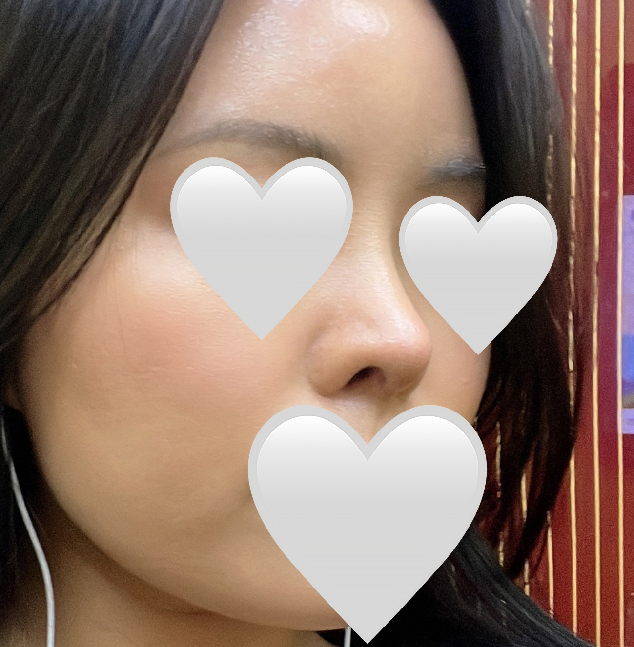 코재수술결심 후 바이브에서 수술했습니다!