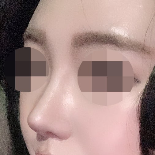 콧대+코끝 수술ㅎㅎ