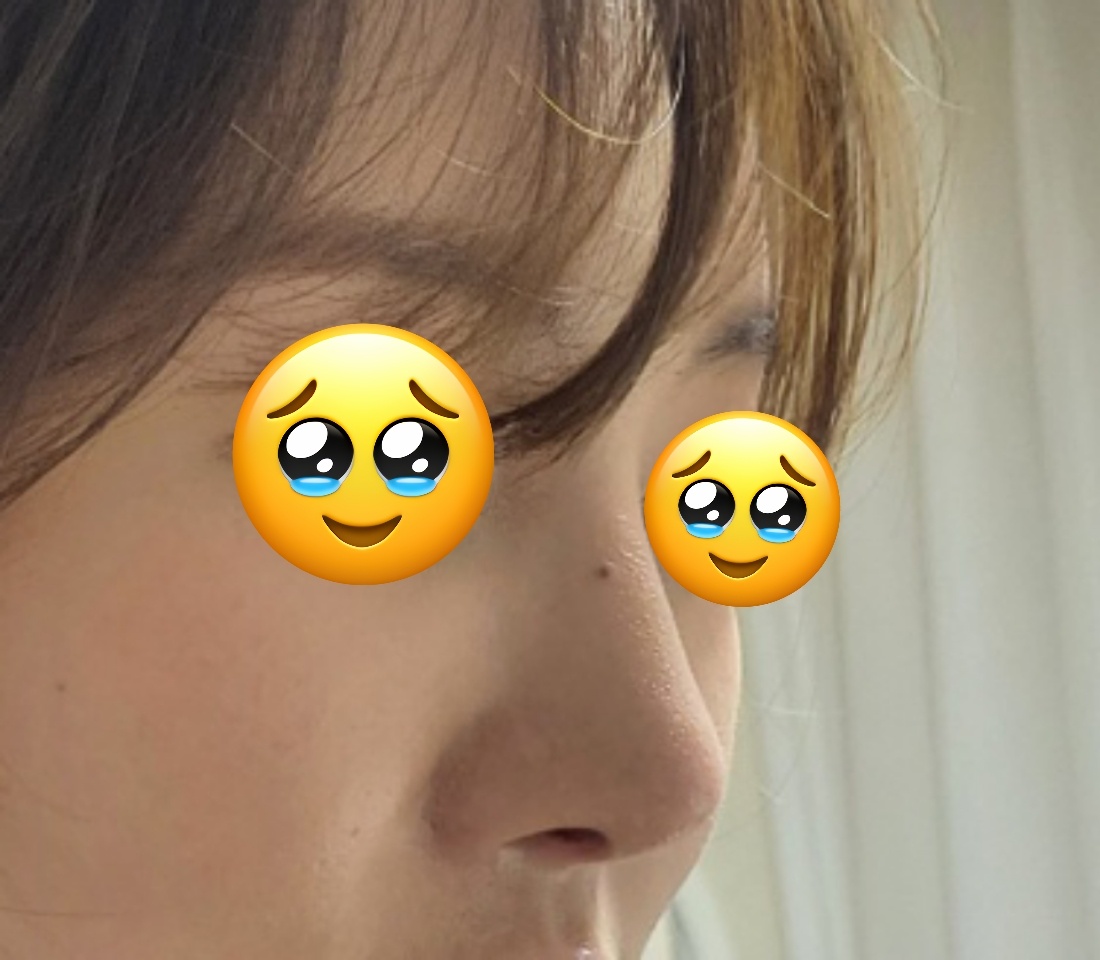 코재수술 적극 추천!