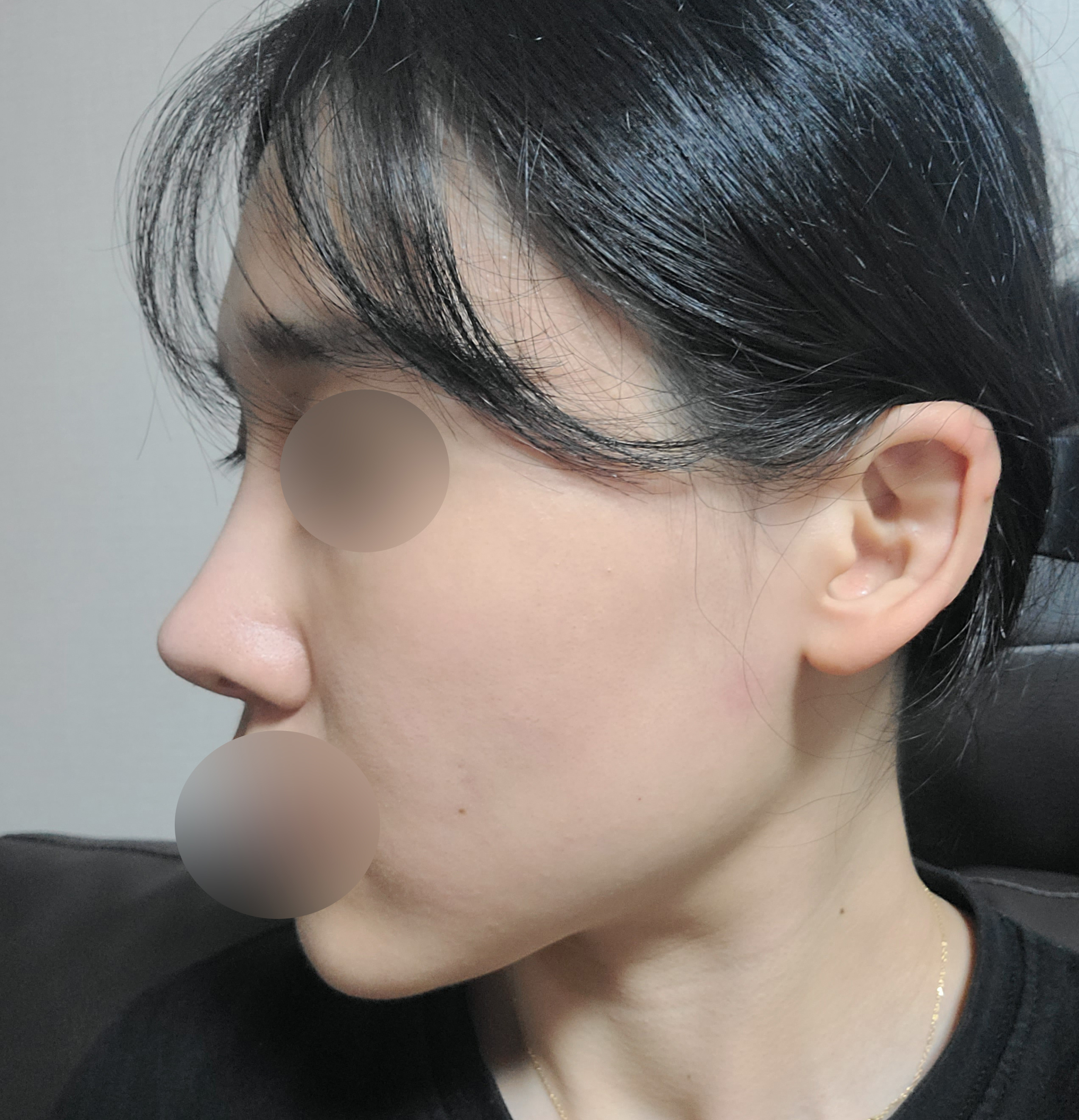 사후관리까지 굿ㅎㅎ 코 6개월차돼써요!