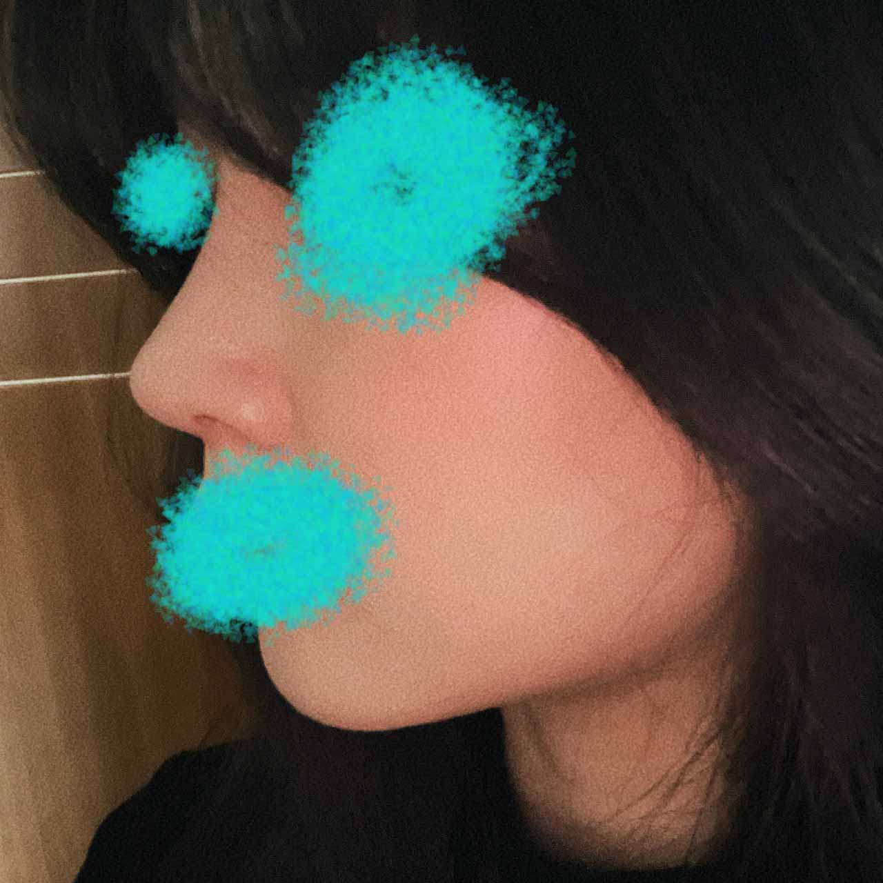 코수술 3개월차 사진찍는맛에 살아요