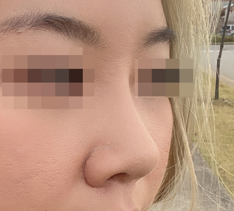 니즈에 맞게 수술해주세용 ㅎㅎ눈, 코성형 5갤차:)