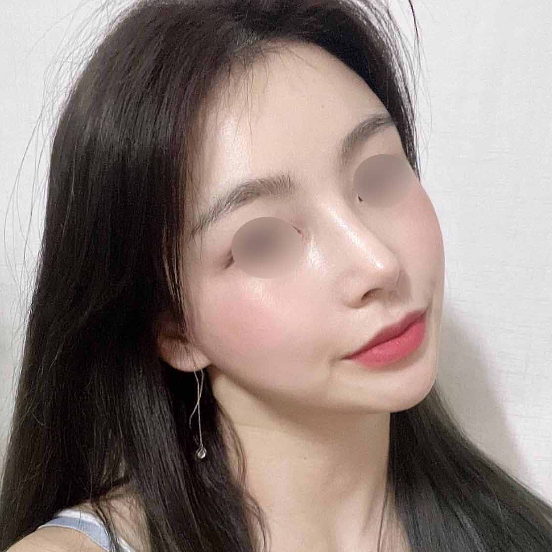 코/지방이식/지방흡입/실리프팅 3개월차!