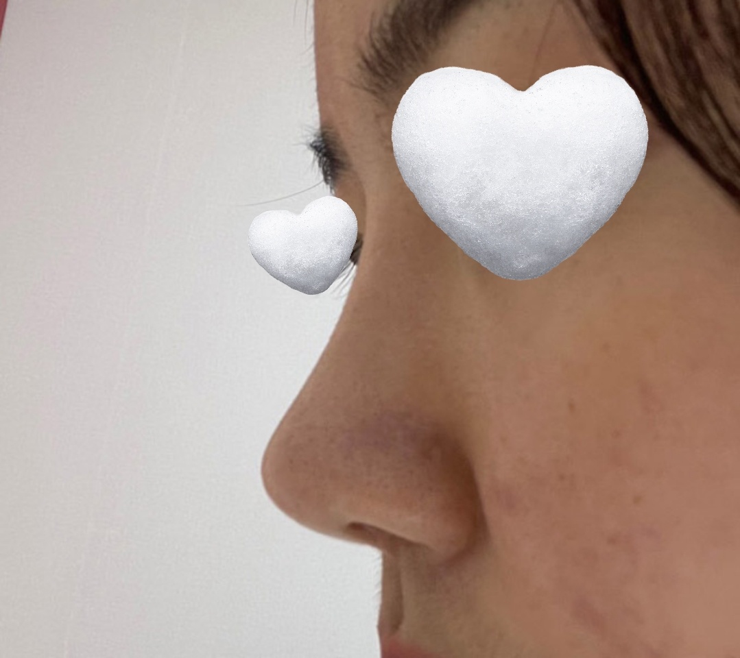 복코성형 4개월지났어용