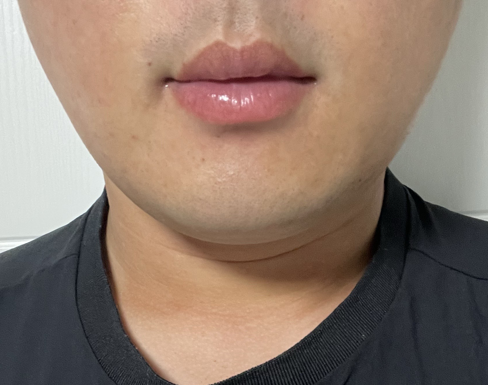 지방흡입, 심부볼제거 효과 좋아요