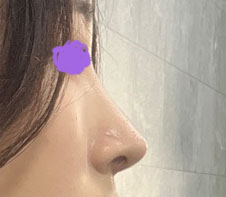 무보형물코수술 만조옥><!!!소문내고 다녀욥ㅎㅎ