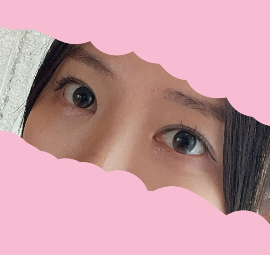 부분절개, 앞트임 7갤차에용