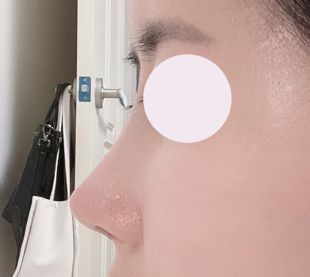 눈3번째수술&기능코수술후기