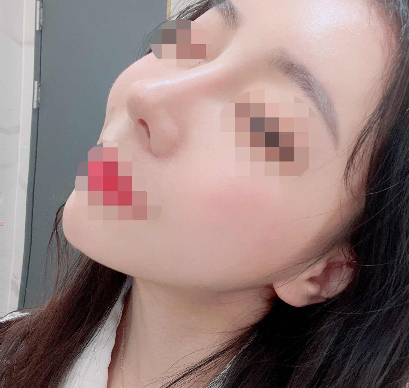 코재수술 4개월차 후기!!