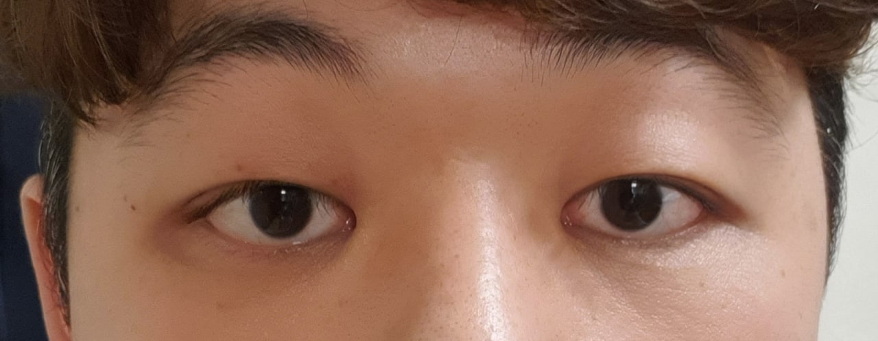 남자 절개눈매교정 후기