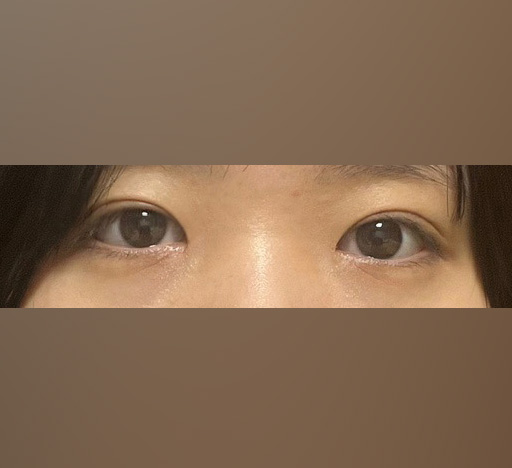 졸린눈!!눈매교정으로 개선했습니다