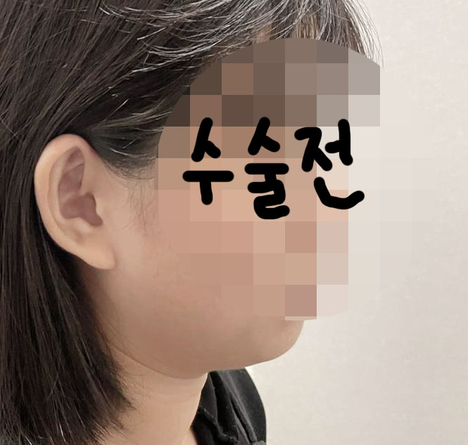 수술전_1_.jpg