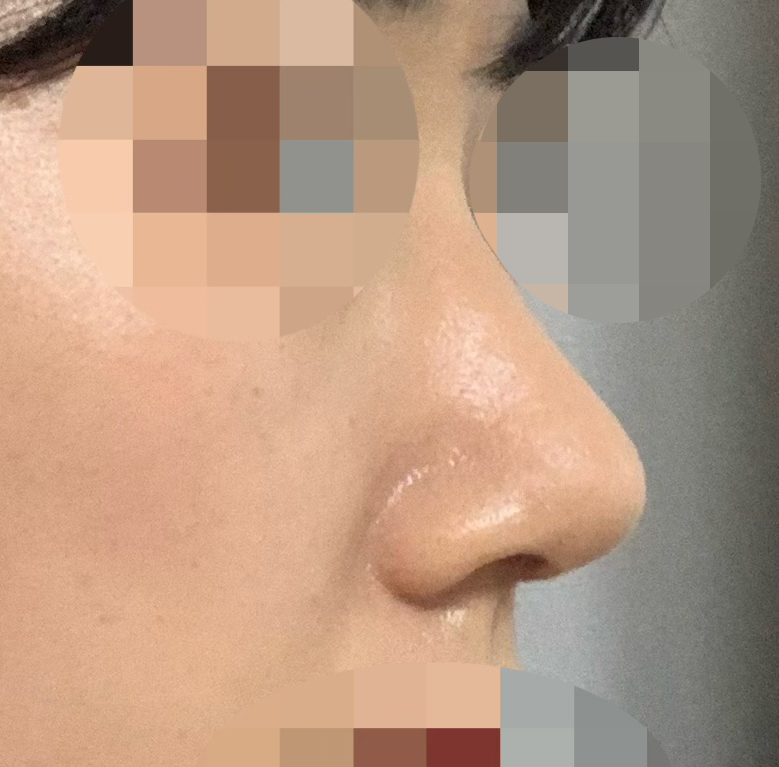 매부리코성형!! 고민끝에 한 후기