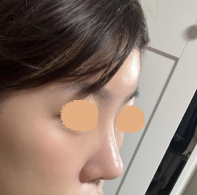 코, 지방이식 바이브에서 수술한 후깅~