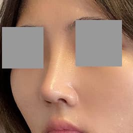 눈재수술, 코수술 만족해요