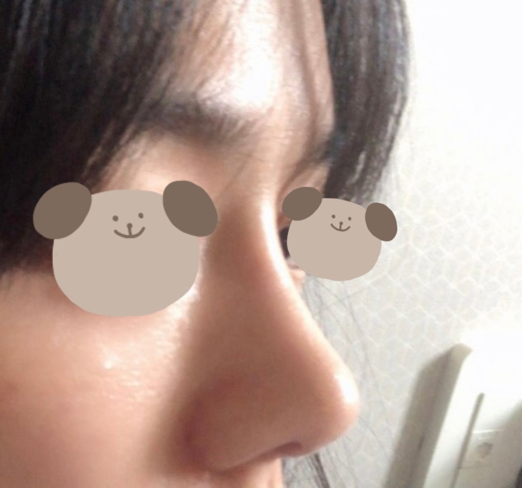 코재수술 만족입니다!