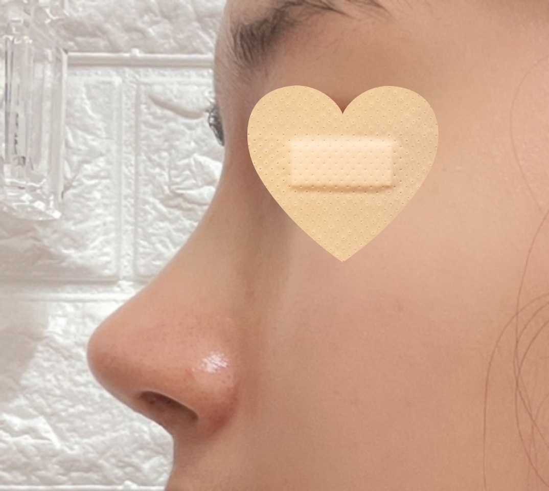 복코성형 만족만족