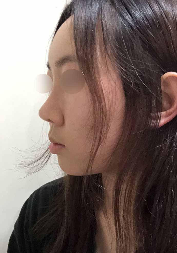 코성형+지방이식=무조건 하세요 ㅋㅋ